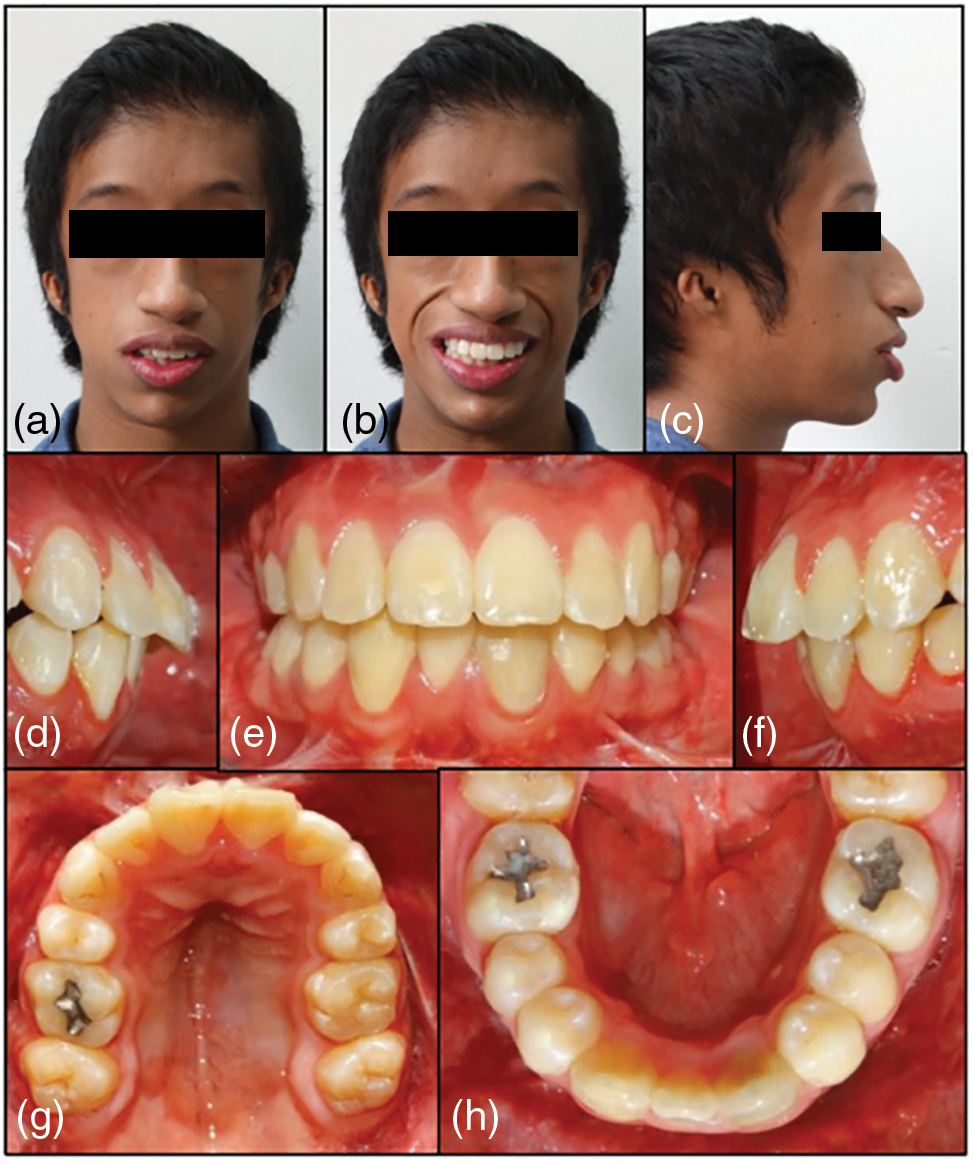 Orthodontic and Surgical Management of Meir-Gorlin Syndrome: 7 Years of ...