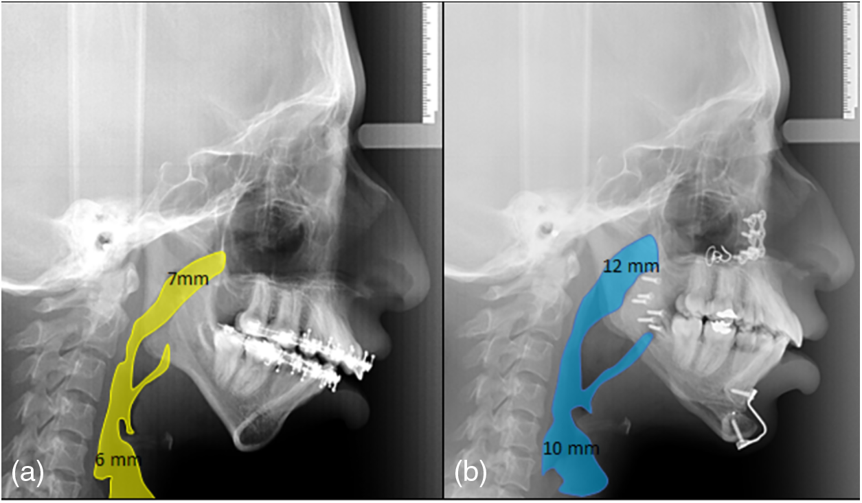 Orthodontic and Surgical Management of Meir-Gorlin Syndrome: 7 Years of ...